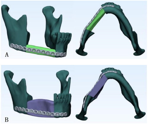 Figure 5. 3D-printed surgical plates designed for the mandible reconstructed with free fibula flap (A) and deep circumflex iliac artery flap (B).