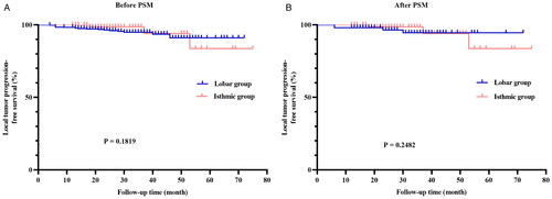 Figure 1. Kaplan–Meier analysis of local tumor progression-free survival in the isthmic and lobar groups before (A) and after (B) propensity-score matching.