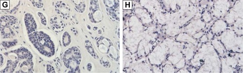 Figure 6 Expression of LC3 in salivary gland ACC and normal salivary gland tissues (IHC, SP).