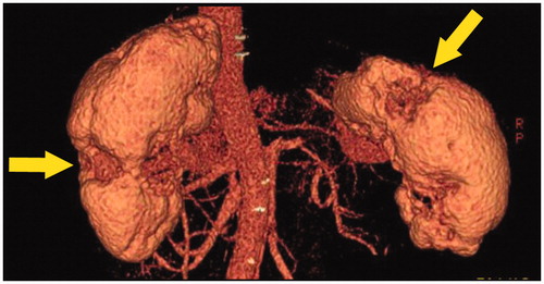 Figure 7. Three-dimensional CT findings. Multiple partially severely atrophied areas (arrows) were seen despite relatively preserved renal function.