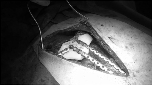 Figure 3 Intraoperative picture: 3D sternal implant filling the defect after tumor resection fixed to bone scaffolds by titanium plates.