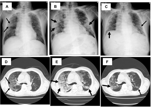 Figure 2 Chest X-ray (A–C) and computed tomography (D–F) of the case 2 patient on day 10 (A and D), day 15 (B and E), and day 30 (C and F). GGOs are found in both lung fields on day 10 (A and D). They were worse and lesions, including the densities were increased on day 15 (B and E), but they have finally improved on day 30 (D and F). Arrows indicated the abnormal shadows in chest X-ray and CT, such as interstitial shadows and GGO.