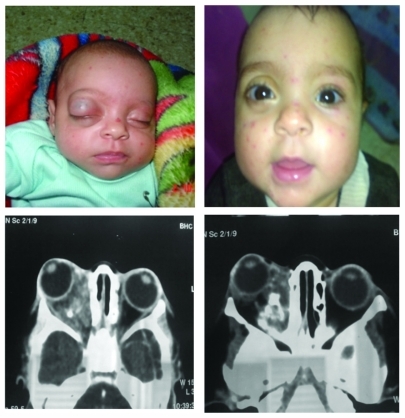 Figure 4 A 2-week-old girl with a right deep orbital hemangioma causing proptosis prior to and 3 months after treatment; computed tomography scan with enhancement shows a change in the size and appearance of the lesion being initially homogenous in the proliferative phase, then becoming heterogenous denoting fibrofatty degeneration when starting involution.