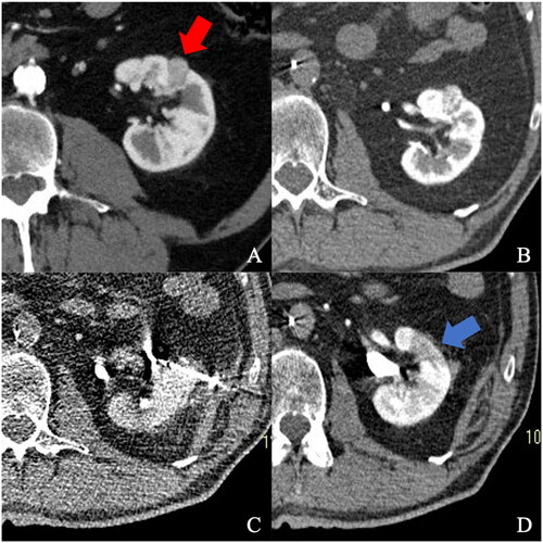 Figure 2. (A) Patient #1 CECT showing a small, intraparenchymal renal cell carcinoma at the ventral mid-third of the left kidney (red arrow). (B) Arterial phase CTRA of the left kidney; in this image the renal nodule shows an increased conspicuity if compared to the CECT enhancement. C) Microwave probe with its tip precisely deployed inside the nodule. D) Venous phase CTRA showing the necrotic area, with the ghost tumor fully included (blue arrow). Notes: CECT: contrast-enhanced CT; CTRA: CT renal arteriography.