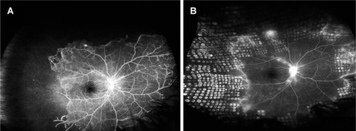 Figure 6 Wide-field fluorescein angiography in a case of IRVAN; an 11-year-old girl who presented with blurring of vision both eyes.