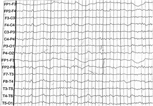 Figure 4. EEG showed slowing waves.