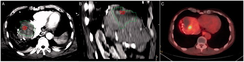 Figure 3. Colorectal metastasis (red) ablation in the liver dome. Ablation zone (green) with adequate margins in the axial plane (A), but suboptimal margins in sagittal plane examination (B). Local tumor progression is evident on a 10-month PET/CT follow-up scan (C).