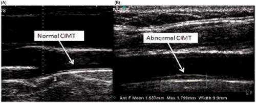 Figure 1. Ultrasound image of carotid artery. CIMT (carotid intima-media thickness). (A) No plaque, no CIMT thickness (no atherosclerosis). (B) CIMT, carotid plaque (atherosclerosis).