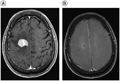 Figure 1. Brain MRIs prior to and after high dose-methotrexate treatment. (A) Brain MRI prior to biopsy showed homogenous enhancing masses on post contrast T1 image. (B) Brain MRI showed resolution of lymphoma lesions on post-contrast T1 image after induction high dose-methotrexate treatment.