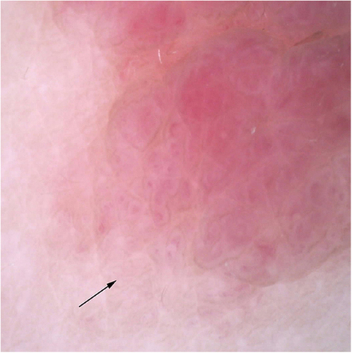 Figure 6 After 3 months of treatment, the intensive vascular network gradually disappeared. The black arrow indicates the same landmark for comparative dermoscopic observations.