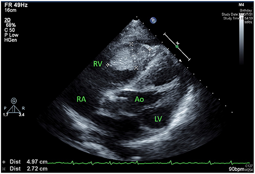 Figure 1 Echocardiogram performed on July 31, 2020 showing a 4.97×2.72 cm mass-like echogenicity on the right ventricular free wall.