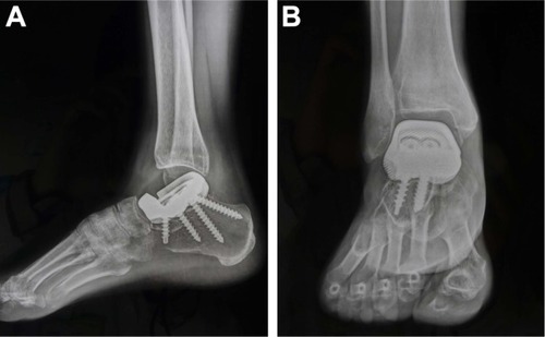 Figure 7 Follow-up radiographs 6 months after surgery.