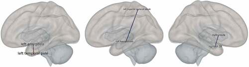 Figure 3. Functional connectivity.Positive connectivity After treatment, at the end of the extinction the left amygdala in the EMDR group shows an increase of its connectivity with the left posterior division of the inferior temporal gyrus, a part of the temporal pole (F = 0.87; intensity = 4.41; p FDR < .022) compared to the wait-list group. Lateral and anterior view. Negative connectivity After treatment, at the end of the extinction, the left hippocampus in the EMDR group shows a decrease of its connectivity with the left superior parietal lobule (F = 1.13; intensity = 4.73; p FDR < .01) compared to the wait-list group. Lateral and anterior view. After treatment, at the end of the extinction, the right insula in the EMDR group shows a decrease of its connectivity with the right ventral entorhinal cortex (BA 28) (F = 1.95; intensity = 4.8; p FDR < .008) compared to the wait-list group. Anterior and lateral view. Fear extinction learning improvement in PTSD after EMDR therapy: an fMRI study.