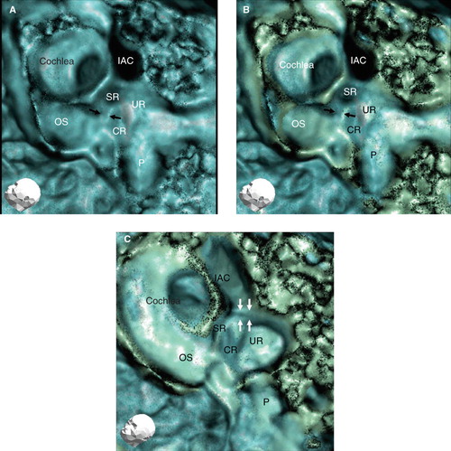 Figure 3. Findings of a representative 3D CT image of a healthy human subject (left ear). (A) With low-level bone CT window (blue color). (B) With low - and high- level bone CT windows (blue and green color). (C) The image shows a view from directly above the sulciform groove with the same CT window level as in (B). A more accurate image of the sulciform groove of the saccular duct and endolymphatic sinus can be judged by referring to the CT images in (A, B, and C) The method in (C) is suitable for assessment of the sulciform groove of the saccular duct and endolymphatic sinus. With two different bone densities the CT view manifests more three-dimensionally. The cochlear lateral wall and basal portion of the osseous spiral lamina in green seem to be denser in bone density than the vestibule and the apex of the cochlea in blue. CR, cochlear recess; IAC, internal auditory canal; OS, osseous spiral lamina; P, posterior semicircular canal; SR, saccular recess; UR, utricular recess. Black arrows, YT groove; white arrows, the sulciform groove of the saccular duct and endolymphatic sinus.