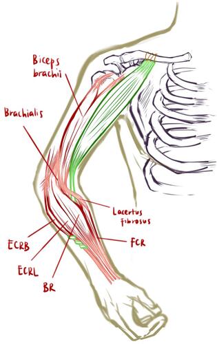 Figure 1 Free functional muscle transfer (FFMT) surgical technique illustration. The origin of the transferred gracilis muscle was implanted directly to the periosteum middle-third clavicle with continuous suture through proximal tendon part of gracilis muscle. The distal tendon was placed underneath the lacertus fibrosus and mobile wad compartment, and then attached to the proximal side of the Extensor Carpi Radialis Brevis (ECRB) tendon. Green coloured: Gracilis muscle.