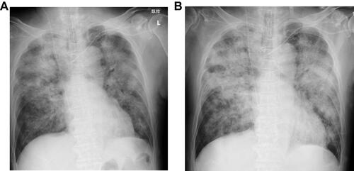 Figure 2 Chest radiographs obtained on day 3 (A) and 5 (B).