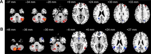 Figure 1 Altered resting-state functional connectivity (rsFC) areas of the cerebellum posterior lobe (CPL) in the normal sleep group.