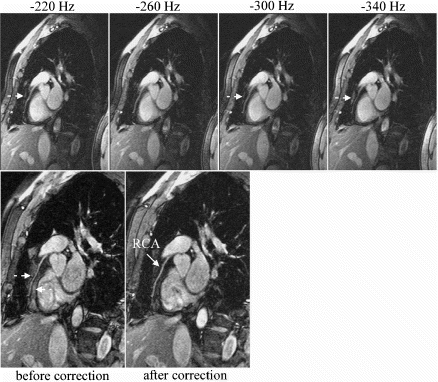 Figure 2. Fat frequency scout images (top row), and images acquired using the 3D true-FISP sequence before and after correction of the fat saturation pulse frequency offset (bottom row). The 3D true-FISP image with the fat saturation pulse at −210 Hz offset (before correction) shows that the fat signal surrounding the coronary artery is not suppressed (dashed arrows). The scout images acquired with the variation in the fat saturation pulse frequency offset indicate that the best suppression is obtained with a frequency offset of −260 Hz for the chemical shift pulse. When the fat saturation pulse frequency offset is set to −260 Hz, the 3D true-FISP image (after correction) shows much better suppression of the fat signal. Notice that the phase cancellation of the signal at the boundaries of the RCA in the pre-correction image is reduced in the image acquired after correction.