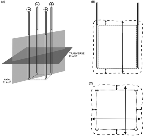Figure 2. (A) Measurement of the ablation zone size, definition of planes. (B) Measurements in the axial plane: - - - - rectangle defined by the active parts of the electrodes; – – – – coagulation zone; small arrows, axial margins outside this rectangle; large arrow, axial diameter. (C) Measurements in the transverse plane: ···· square defined by the active parts of the electrodes; – – – coagulation zone; small arrows, lateral margins outside this square; large arrows, transverse diameters.