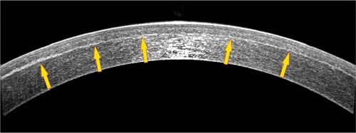 Figure 1 Anterior-segment optical coherency high-resolution cross-sectional (6 mm) image of an eye treated with LASIK-CXL for −2.25 D of sphere and −0.25 D of astigmatism, obtained 1-year postoperatively. Blue arrows indicate the LASIK flap, while yellow arrows indicate the stromal hyper-reflection line, which correlates with the depth of the prophylactic cross-linking effect.