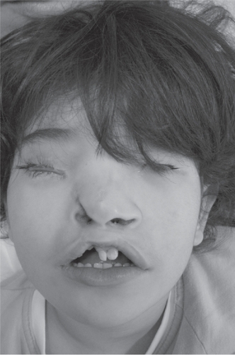 Figure 6 Case 2 at age 6 years. Note typical facial phenotype.