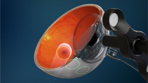 Figure 1 Diagram showing the location of three collimated beams of radiation passing through the inferior sclera (green circles) to avoid the crystalline lens, during stereotactic radiotherapy.