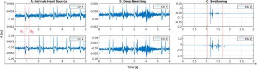 Figure 9 Exemplary recordings of (A) vascular sound with intrinsic heart sounds S1 and S2, (B) during deep breath and (C) during swallowing of the subject as common artifacts. The recordings were acquired in one measurement. The upper graph depicts the acquired signal with added membrane (Ch 1) and the lower graph without membrane (Ch 2).