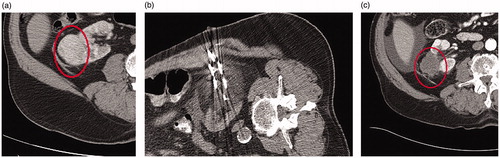 Figure 1. Seventy-two-year-old male presents with a large 7 cm right renal mass. Due to extensive medical comorbidities, he was referred for cryoablation. Preablation contrast-enhanced axial CT demonstrates a 7 cm solid exophytic mass arising from the lower pole right kidney (A). Seven cryoablation needles were placed into the mass using US/CT guidance and a 12 min freeze-5 min passive thaw-12 min refreeze was performed (B). Contrast enhanced CT at 28 months post ablation demonstrates no evidence of residual disease (C).