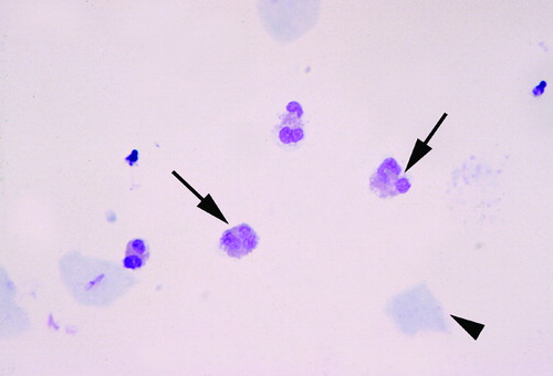 Figure 1.  Eosinophils in the amniotic fluid. Amniotic fluid obtained from a patient with spontaneous preterm labor and intact membranes. The eosinophils (arrows) were the predominant cells in the amniotic fluid (arrowhead: epithelial cell).