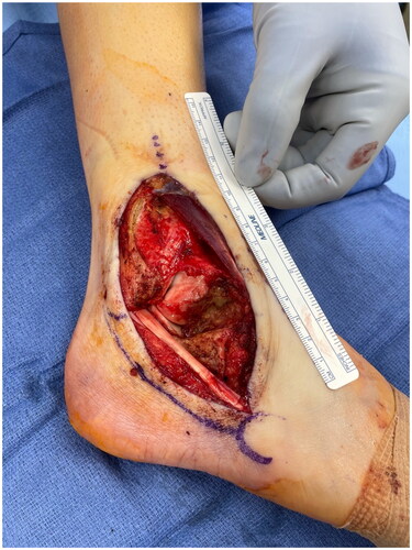 Figure 1. Pre-radial forearm flap soft tissue defect.