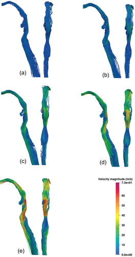 Figure 6. Lateral (left) and posterior (right) views of URT streamlines coloured by velocity magnitude for each inspiratory flow rate. (a) 30 L/min, (b) 60 L/min, (c) 120 L/min, (d) 180 L/min, and (e) 240 L/min.