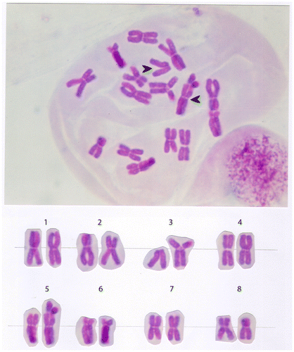 Figure 7. Translocation (t: 3p –; 5p+) in the chromosome set of the onion (Allium cepa L).