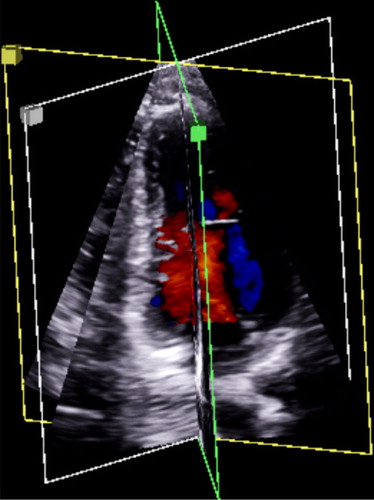 Figure 1. Triplane echocardiography provides three planes from the same heartbeat with high temporal and spatial resolutions.