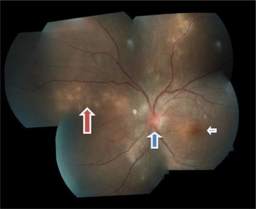 Figure 1 Left fundus showed swollen optic disc (blue arrow) with macular star (white arrow) and crops of active choroidal lesions at superonasal retina with a linear arrangement in the form of migratory track nasally (red arrow).