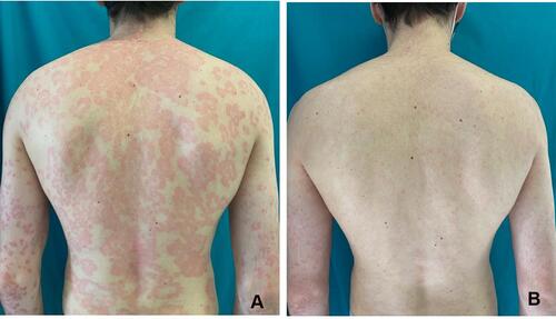 Figure 1 A 27-year-old man affected by moderate to severe psoriasis presenting with erythematous-desquamative plaques on the back (A). Complete cutaneous clearance after 12 weeks treatment with an IL-23 inhibitor (B).