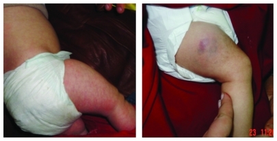 Figure 5 Thigh of a 2-month-old child showing peripheral vascular ischemic changes at 3 weeks from propranolol hydrochloride administration; mottling became more apparent after 4 weeks. These changes were reversible.