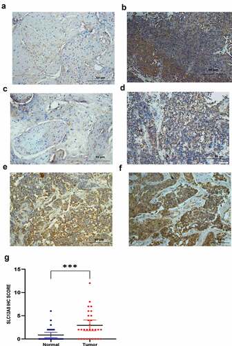 Figure 4. SLC12A8 protein expression in tissues. Representative images of SLC12A8 in adjacent tissues (a) and in bladder tumor tissues (b). Bladder tumor tissues were divided into four grades according to the staining intensity: negative (c), weak (d), moderate (e) and strong (f). Immunohistochemistry score of SLC12A8 in 29 pairs of bladder cancer and adjacent normal tissues (g). ***P < 0.001