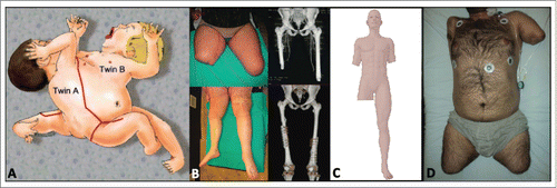 Figure 1. Overview of lower extremity transplantation recipients. (A) Illustration of Case 1, ischiopagus twins separated by Zuker et al. with complete lower extremity transplantation from twin A to twin B, including pelvic bone and hip socket. Source: Ref. 6. © Georg Thieme Verlag KG. Reproduced by permission of Georg Thieme Verlag KG. Permission to reuse must be obtained from the rightsholder. (B) Pre- and postoperative photographs and 3D CT reconstructions of Case 2 by Cavadas et al., showing right mid- and left distal femoral allotransplantation. Source: Ref. 7. © 2013 John Wiley and Sons, Inc. Reproduced by permission of John Wiley and Sons, Inc. Permission to reuse must be obtained from the rightsholder. (C) Illustration of recipient from Case 3. Of note, exact levels of amputation/transplantation are unknown due to lack of literature. (D) Preoperative photograph of the recipient from Case 4, demonstrating right shoulder level, left trans-humeral, and bilateral mid-femoral amputation levels. Source: Ref. 22. © 2014 Wolters Kluwer Health. Reproduced by permission of Wolters Kluwer Health. Permission to reuse must be obtained from the rightsholder (reprinted with permission from Nasir S, Kilic YA, Karaaltin MV, et al. Lessons learned from the first quadruple extremity transplantation in the world. Ann Plast Surg 2014; 73(3):336-40; promotional and commercial use of the material in print, digital or mobile device format is prohibited without the permission from the publisher Lippincott Williams & Wilkins. Please contact journalpermissions@lww.com for further information).