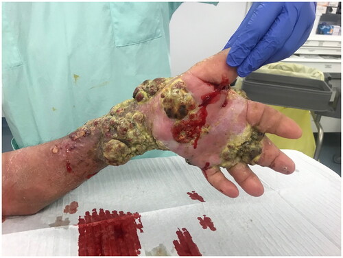 Figure 5. Lesions of the hand with a palmar view before surgery.