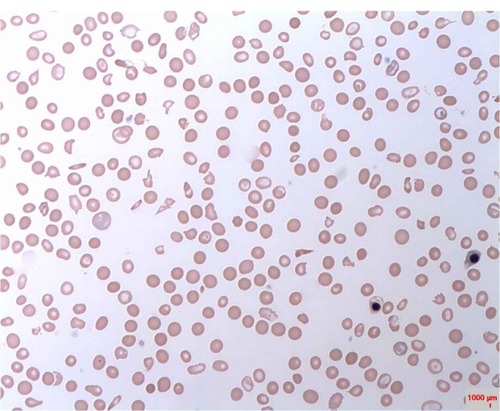 Figure 2 A characteristic blood film from one of the glucose-6-phosphate dehydrogenase-deficient children.