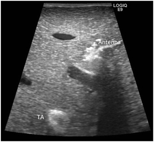 Figure 8. Transverse sonographic image of porcine liver demonstrates heterogeneous shadowing at the site of the microwave antenna. The TA appears moderately echogenic.