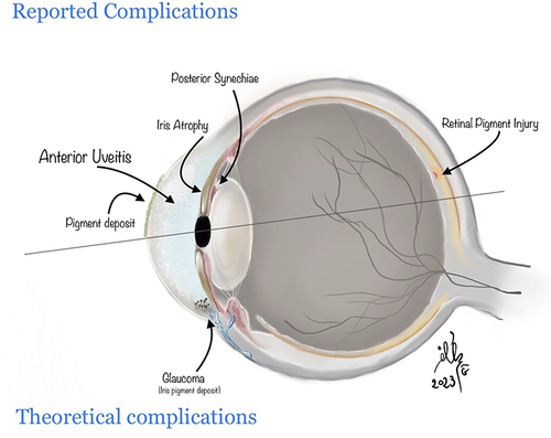 Figure 2 Ocular complications reported following exposure to IPL or Diode laser.