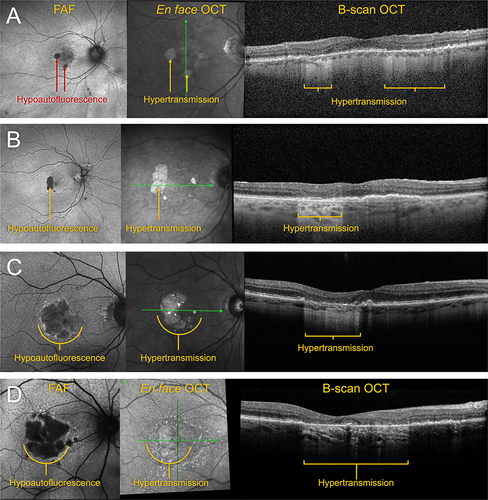 Figure 6 A) Early nonfoveal GA. (B) Moderate nonfoveal GA, example 1. (C) Moderate nonfoveal GA, example 2. (D) Moderate foveal GA, example 3.