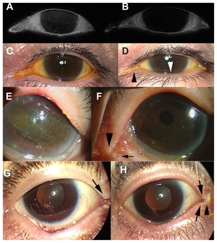 Figure 2 Preoperative and postoperative photographs of patients 1–3. (A) Preoperative photograph of fluorescent dye-stained ocular surface in patient 1. White spots imply superficial punctate keratitis. (B) Postoperative photograph of fluorescent dye-stained ocular surface in patient 1. Superficial punctate keratitis improved. (C) Preoperative photograph of same patient as in Figure 2A. (D) Postoperative photograph of same patient as in Figure 2B. Tear meniscus height elevation (white arrow head) is identified in patient 1. Synechia near the puncta are identified (arrow). (E) Preoperative photograph of patient 2. Severe dry eye is observed. (F) In patient 2, improvements in corneal condition and blepharosynechia (black arrow head) are observed following MBSP. Puncta (arrow) near synechia are still open. (G) Preoperative photograph of patient 3. Corneal filamentosa is observed. (H) In patient 3, improvements in corneal filamentosa and blepharosynechia (black arrow head) are observed postoperatively. Puncta (arrow) near synechia are still open.
