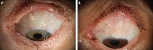 Figure 2 Representative blebs from (A) bevacizumab group and (B) placebo group showing less vascularity in the bevacizumab-treated eye at 6 months postoperatively.