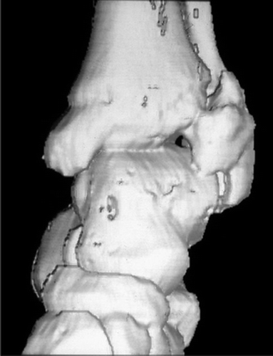 Figure 2. 3D CT scan showing an exostosis arising from the lateral side of the distal epiphysis of the tibia.