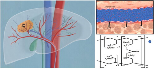 Scheme 1. Proposed schematic picture of sevelamer arsenite nanoparticle functioned as ATO delivery and embolic agent under the activation of endogenous inorganic phosphate (Pi) during chemoembolization therapy of HCC. The cartoon on the left described the procedure of transarterial sevelamer arsenite embolization to treat VX2 tumors under the guidance of DSA. The local magnification of the vessel is indicative of Pi-triggered drug downloading and vessel embolization by sevelamer arsenite where arsenite was incorporated into the framework of sevelamer. In vivo test evidenced the priority of this new chemoembolization therapy over the conventional TACE therapy. To deeply understand the ATO’s enhanced anticancer effect under low Pi stress, Cell viability, apoptosis, expression of Bcl-2, Bax, caspase-3, and release of cytochrome c into the cytosol, mitochondrial membrane potential (Δψm) as well as intracellular reactive oxygen species (ROS) were examined in the normal and low Pi concentration as ATO was incubated with VX2 cells.