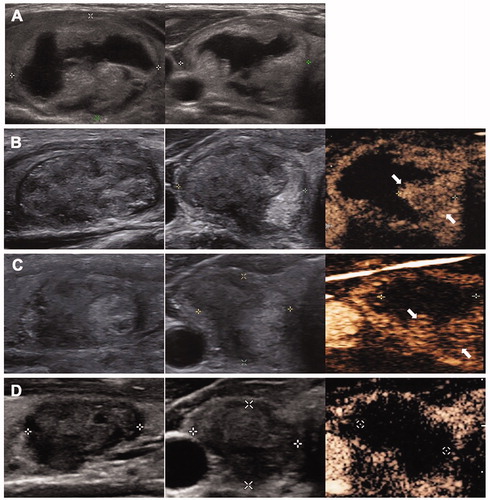 Figure 4. The conventional US and CEUS images of an 18-year-old female in the C group during each ablation (A) A solid nodule located in the right thyroid before treatment with an initial volume of 8.44 ml. (B) At 1 month after the first RFA, the total volume was 3.36 ml and VRR was 60.19%. CEUS showed residual vital tissues located in the peripherally area (arrow). The vital volume was 1.68 ml. (C) At 6 months after the first RFA, the total volume was 1.52 ml and VRR was 81.99%. CEUS showed the vital volume was 1.24 ml. Additional RFA was performed. (D) At 6 months after additional RFA, the total volume decreased to 0.85 ml and VRR was 89.95%.