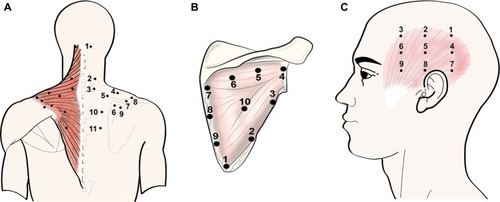 Figure 1 Points of assessment for topographical pressure pain sensitivity maps in the trapezius (A), infraspinatus (B), and temporalis (C) muscles.