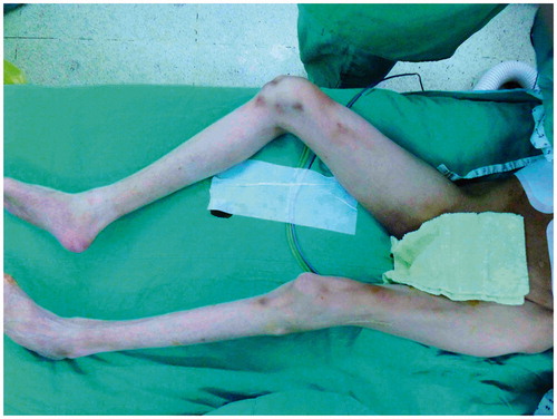 Figure 3. Clinical photograph of Case 2 showing flaccid paralysis with muscle atrophy in both the lower extremities.